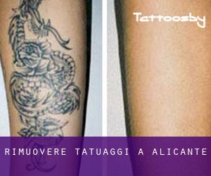 Rimuovere Tatuaggi a Alicante