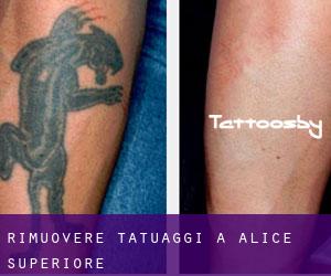 Rimuovere Tatuaggi a Alice Superiore