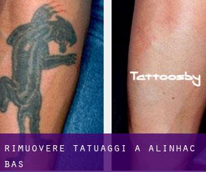Rimuovere Tatuaggi a Alinhac-Bas
