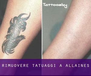 Rimuovere Tatuaggi a Allaines