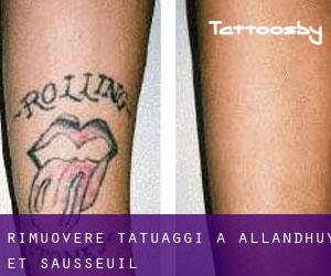 Rimuovere Tatuaggi a Alland'Huy-et-Sausseuil