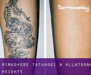 Rimuovere Tatuaggi a Allatoona Heights
