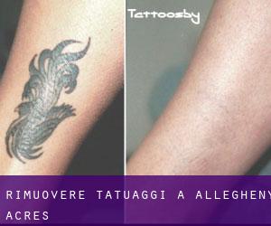 Rimuovere Tatuaggi a Allegheny Acres