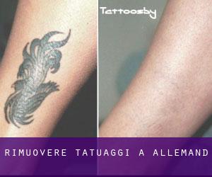 Rimuovere Tatuaggi a Allemand