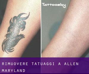 Rimuovere Tatuaggi a Allen (Maryland)