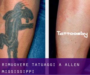 Rimuovere Tatuaggi a Allen (Mississippi)