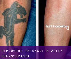 Rimuovere Tatuaggi a Allen (Pennsylvania)