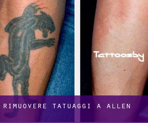 Rimuovere Tatuaggi a Allen