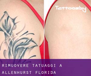 Rimuovere Tatuaggi a Allenhurst (Florida)