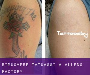 Rimuovere Tatuaggi a Allens Factory
