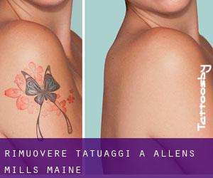Rimuovere Tatuaggi a Allens Mills (Maine)