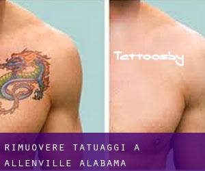 Rimuovere Tatuaggi a Allenville (Alabama)