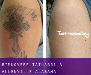 Rimuovere Tatuaggi a Allenville (Alabama)