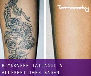 Rimuovere Tatuaggi a Allerheiligen (Baden-Württemberg)