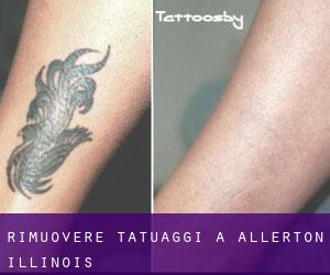 Rimuovere Tatuaggi a Allerton (Illinois)