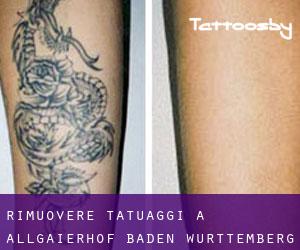 Rimuovere Tatuaggi a Allgaierhof (Baden-Württemberg)