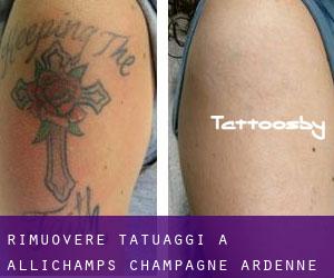 Rimuovere Tatuaggi a Allichamps (Champagne-Ardenne)