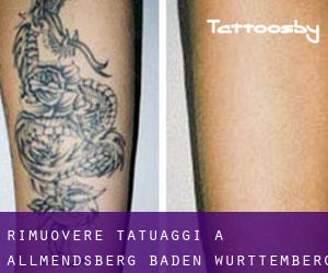 Rimuovere Tatuaggi a Allmendsberg (Baden-Württemberg)