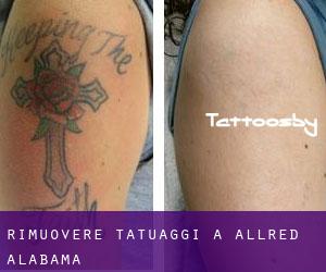 Rimuovere Tatuaggi a Allred (Alabama)