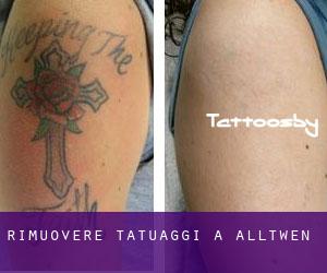 Rimuovere Tatuaggi a Alltwen