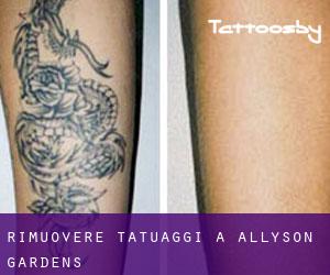 Rimuovere Tatuaggi a Allyson Gardens