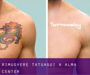 Rimuovere Tatuaggi a Alma Center