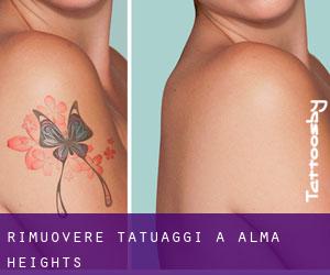 Rimuovere Tatuaggi a Alma Heights