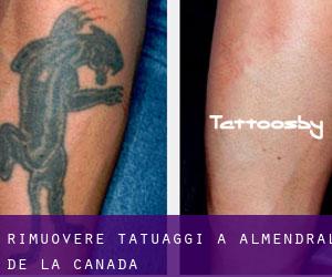 Rimuovere Tatuaggi a Almendral de la Cañada