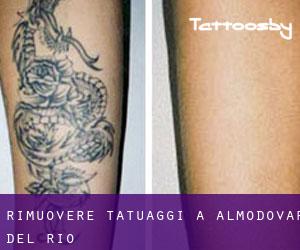Rimuovere Tatuaggi a Almodóvar del Río