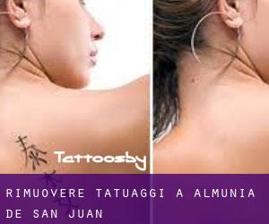 Rimuovere Tatuaggi a Almunia de San Juan