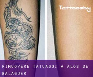 Rimuovere Tatuaggi a Alòs de Balaguer