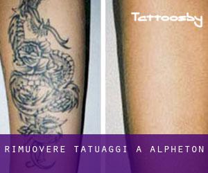 Rimuovere Tatuaggi a Alpheton