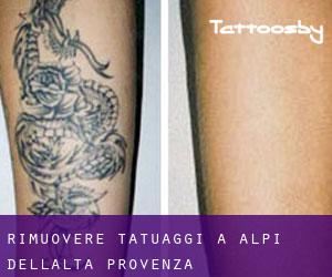 Rimuovere Tatuaggi a Alpi dell'Alta Provenza