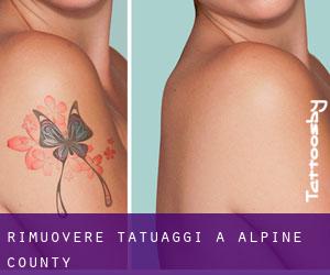 Rimuovere Tatuaggi a Alpine County