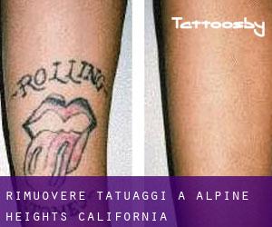 Rimuovere Tatuaggi a Alpine Heights (California)