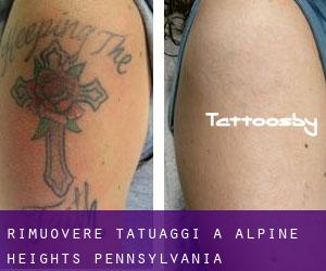 Rimuovere Tatuaggi a Alpine Heights (Pennsylvania)