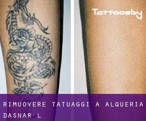 Rimuovere Tatuaggi a Alqueria d'Asnar (l')