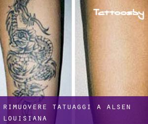 Rimuovere Tatuaggi a Alsen (Louisiana)