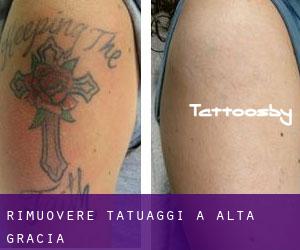 Rimuovere Tatuaggi a Alta Gracia