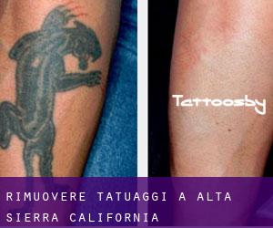 Rimuovere Tatuaggi a Alta Sierra (California)