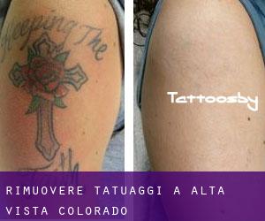 Rimuovere Tatuaggi a Alta Vista (Colorado)