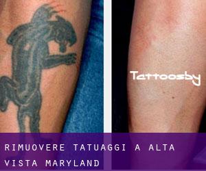 Rimuovere Tatuaggi a Alta Vista (Maryland)