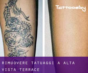 Rimuovere Tatuaggi a Alta Vista Terrace