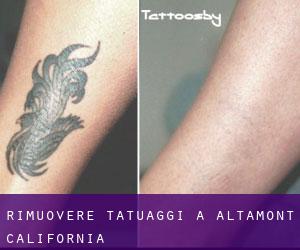 Rimuovere Tatuaggi a Altamont (California)