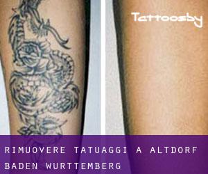 Rimuovere Tatuaggi a Altdorf (Baden-Württemberg)