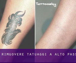 Rimuovere Tatuaggi a Alto Pass