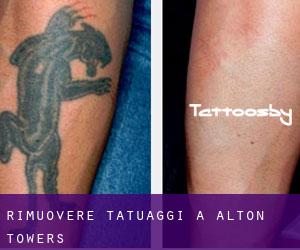 Rimuovere Tatuaggi a Alton Towers