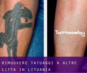 Rimuovere Tatuaggi a Altre città in Lituania