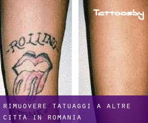 Rimuovere Tatuaggi a Altre città in Romania