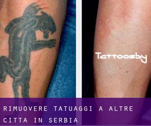 Rimuovere Tatuaggi a Altre città in Serbia